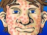 Lutter de maniére naturelle contre l'acné