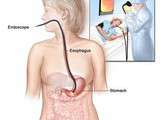Gastro-endoscopie avec biopsie
