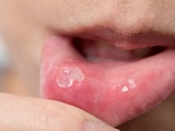 Comment soigner naturellement un aphte dans la bouche